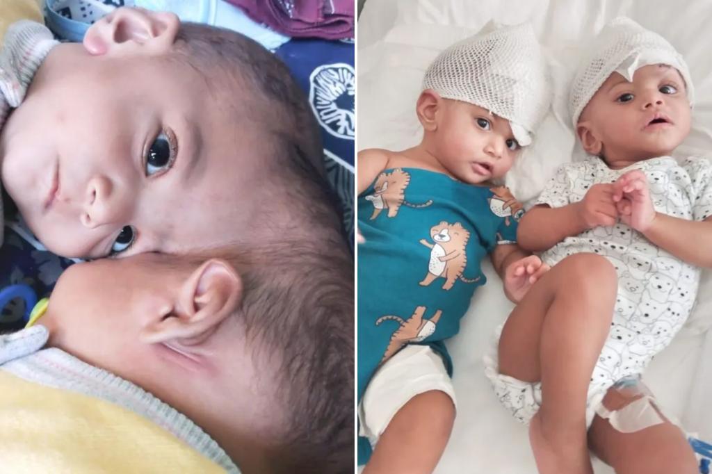 Conjoined twins born with fused brain tissue separated after dangerous 14-hour surgery: 'Truly miraculous'